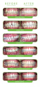 Before and after photo showing effectiveness of Prairie Dental Care's clear braces in Vancouver, WA